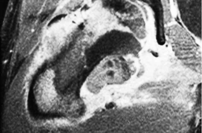Coronal MRI demonstrating soft tissue mass.
